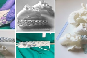 Primera intervención en España de un aneurisma de arco aórtico con ayuda de impresión 3D